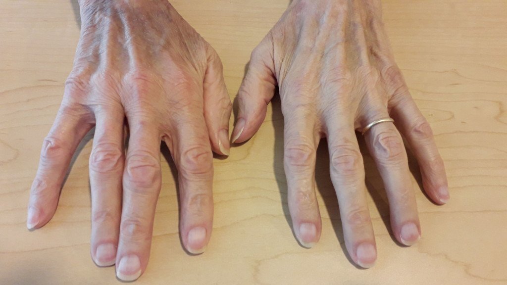 Multimedia en Medicina #15: uñas de Terry