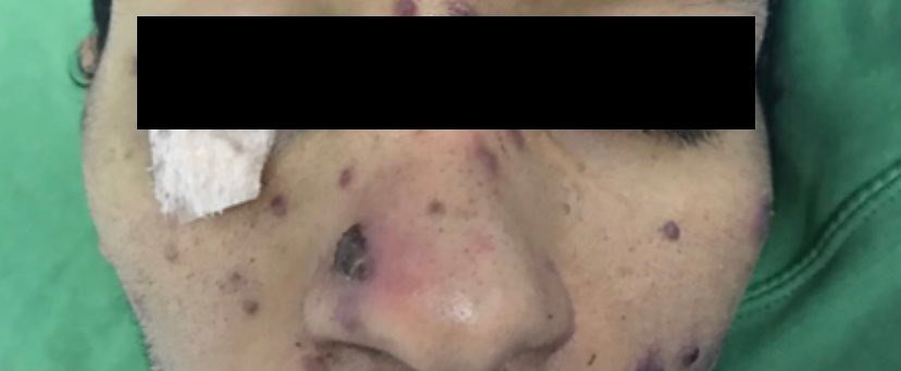 Caso Clínico #38: nódulos violáceos y tricitopenia