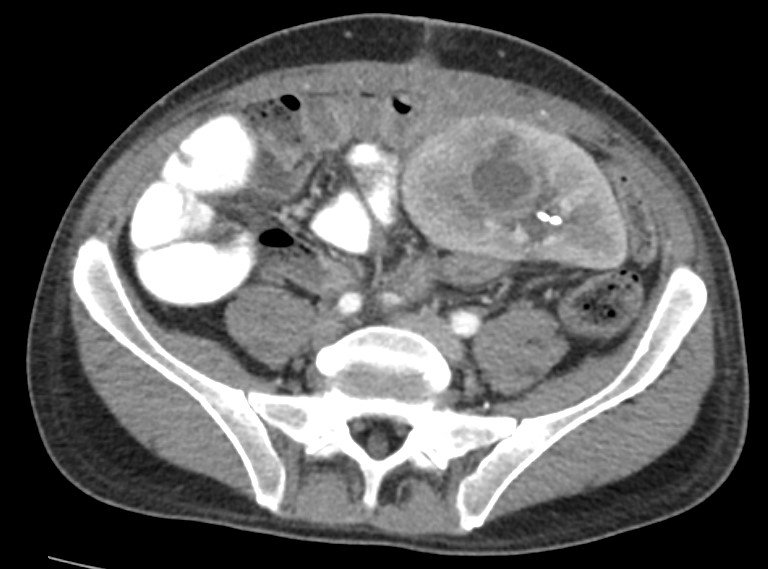 La vida del paciente trasplantado #14: absceso en injerto renal