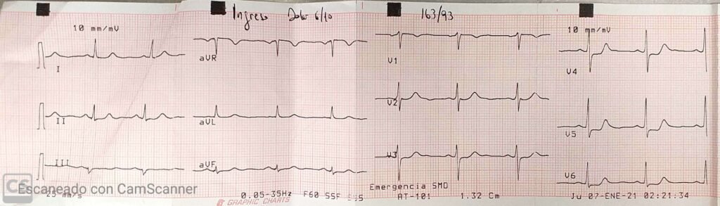 Caso Clínico #46: secuencia electrocardiográfica en paciente con IAM