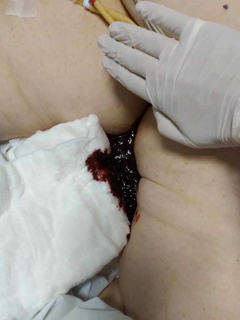 UTI-Club #21: shock hemorrágico por sangrado digestivo grave