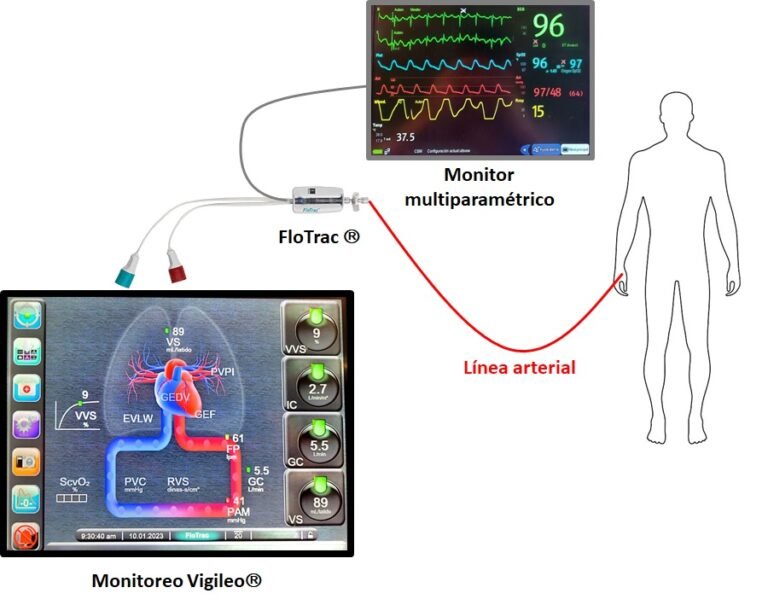 Uti Club Monitoreo Hemodin Mico Semiinvasivo Interconsulta On Line